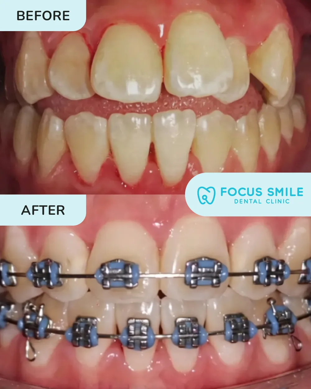 Braces before and after, case 2, at Focus Smile Dental