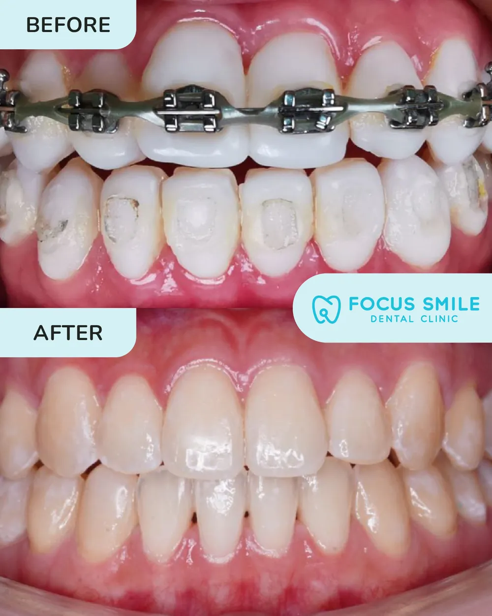 Braces before and after, case 3, at Focus Smile Dental