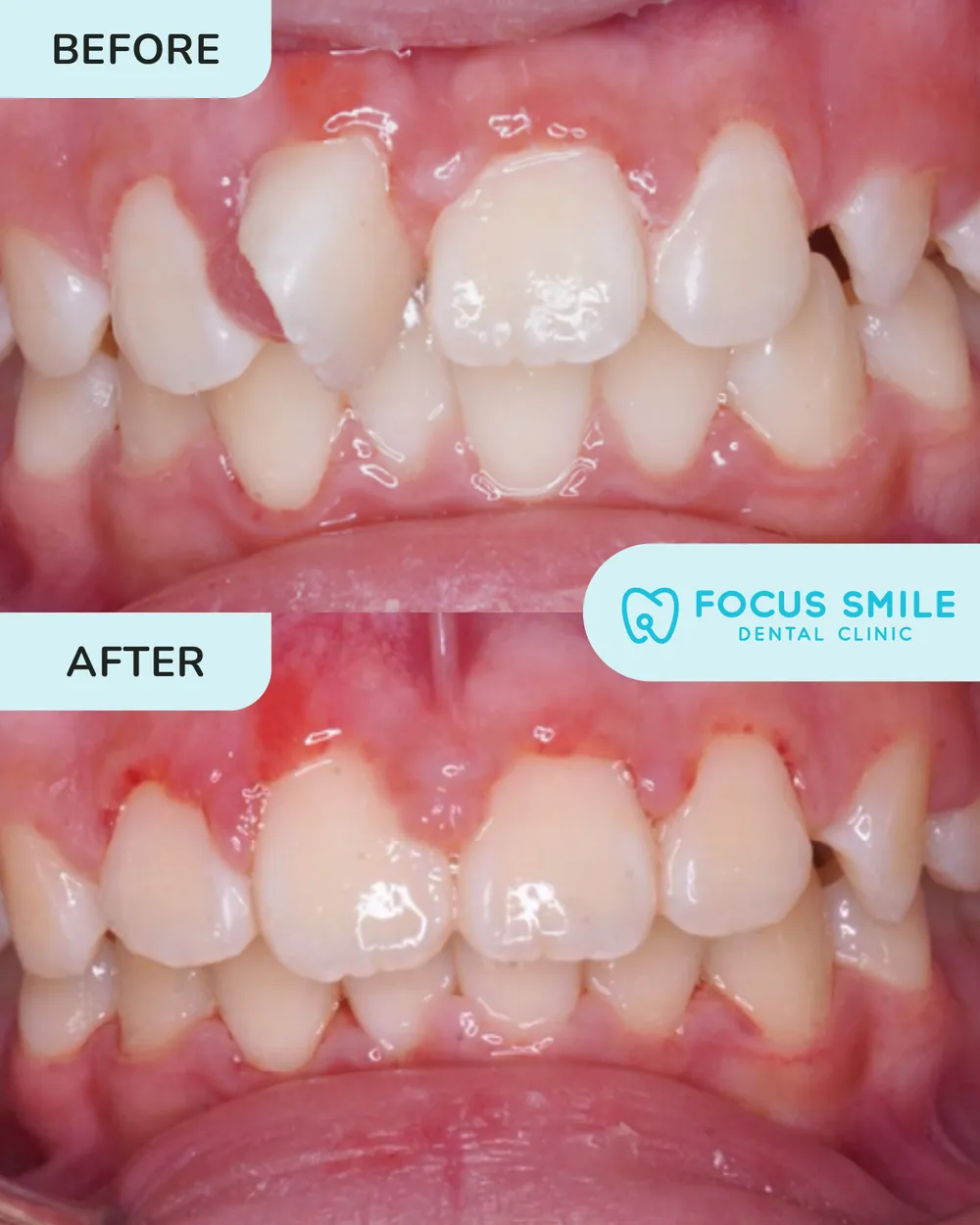 Braces before and after result at Focus Smile Dental