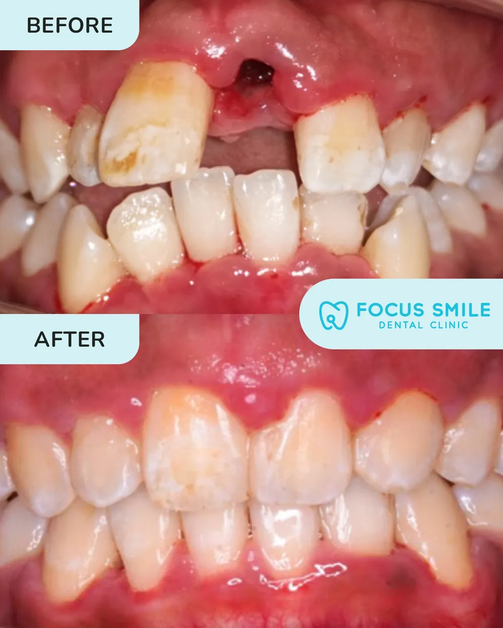 Braces before and after, case 5, at Focus Smile Dental