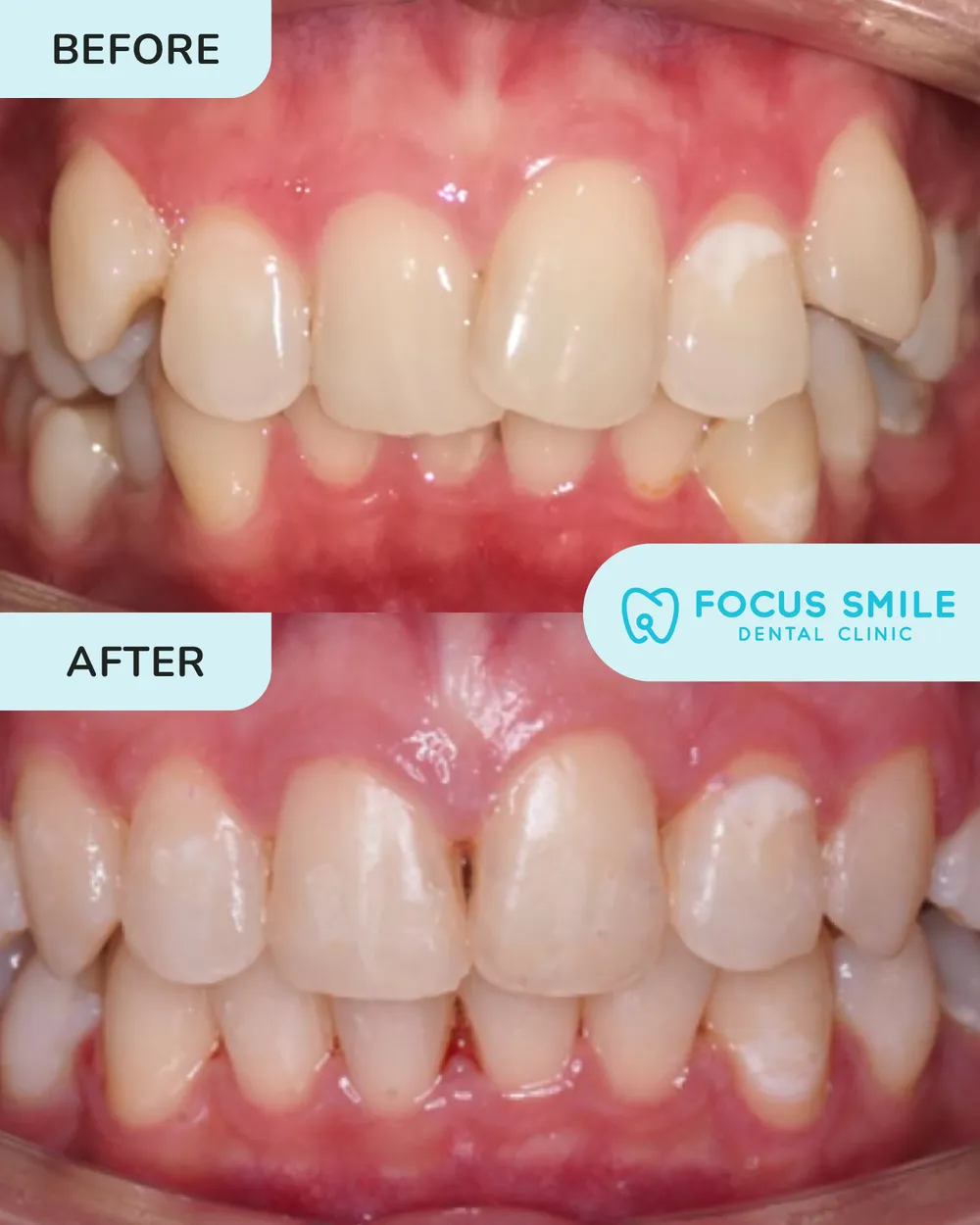 Braces before and after result at Focus Smile Dental