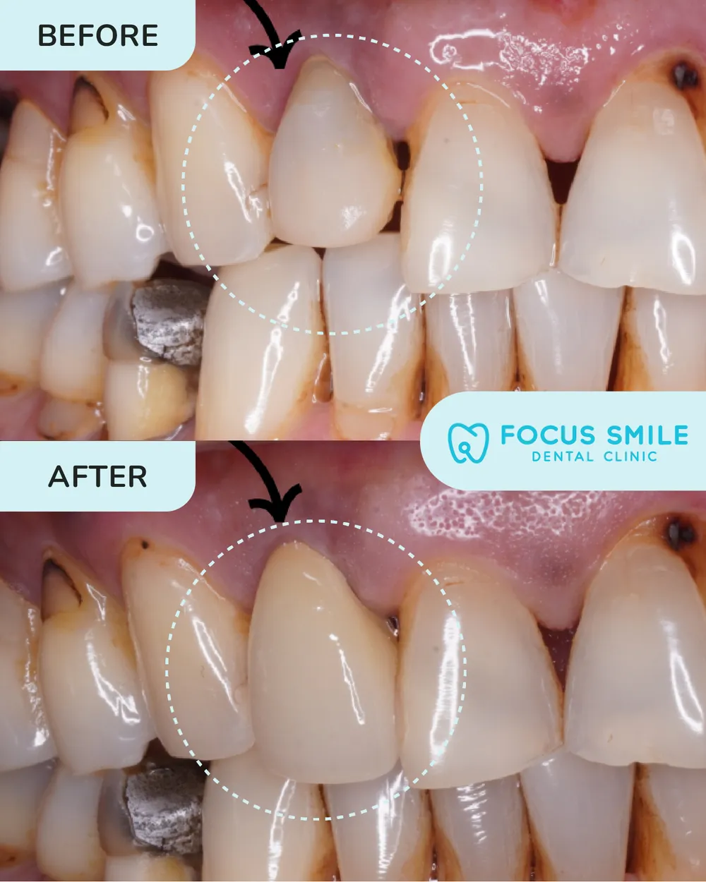 Crowns and bridges before and after, case 1, at Focus Smile Dental