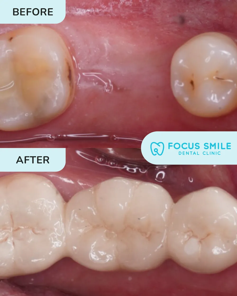 Crowns & Bridges before and after result at Focus Smile Dental