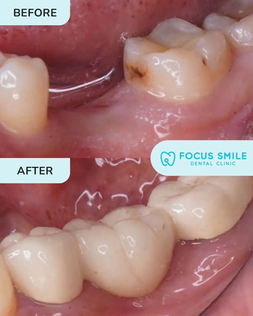 Crowns and bridges before and after, case 3, at Focus Smile Dental