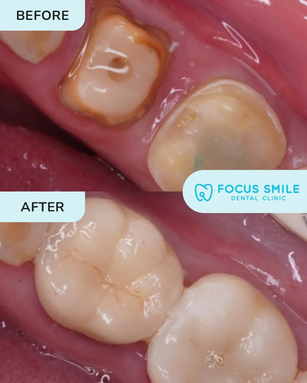 Crowns & Bridges before and after result at Focus Smile Dental
