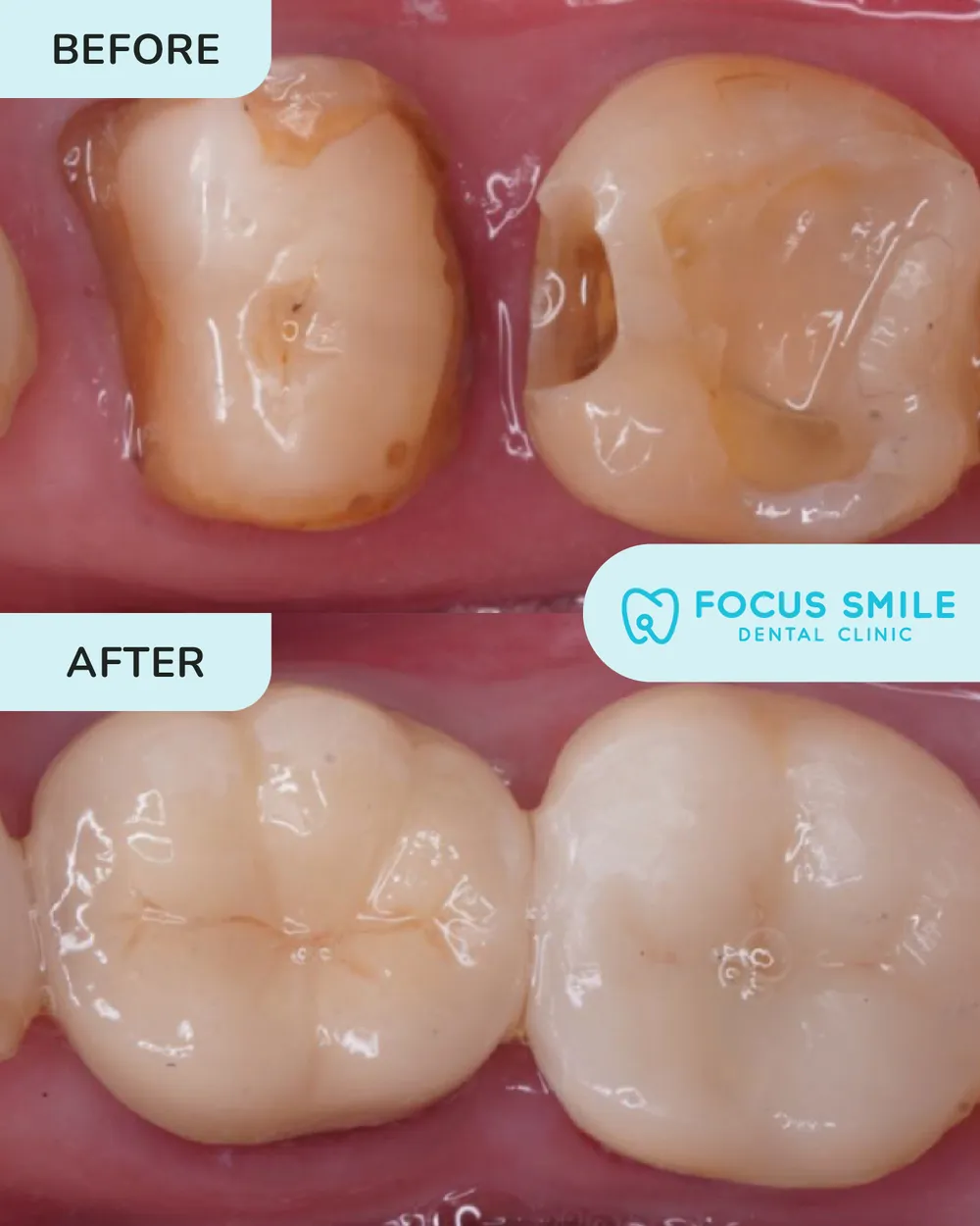 Crowns and bridges before and after, case 5, at Focus Smile Dental