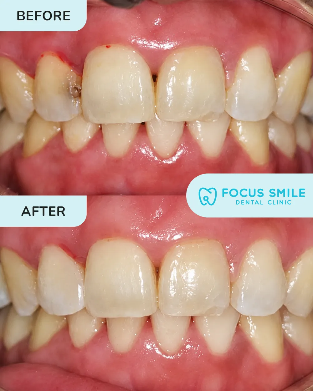 Dental filling before and after, case 3, at Focus Smile Dental