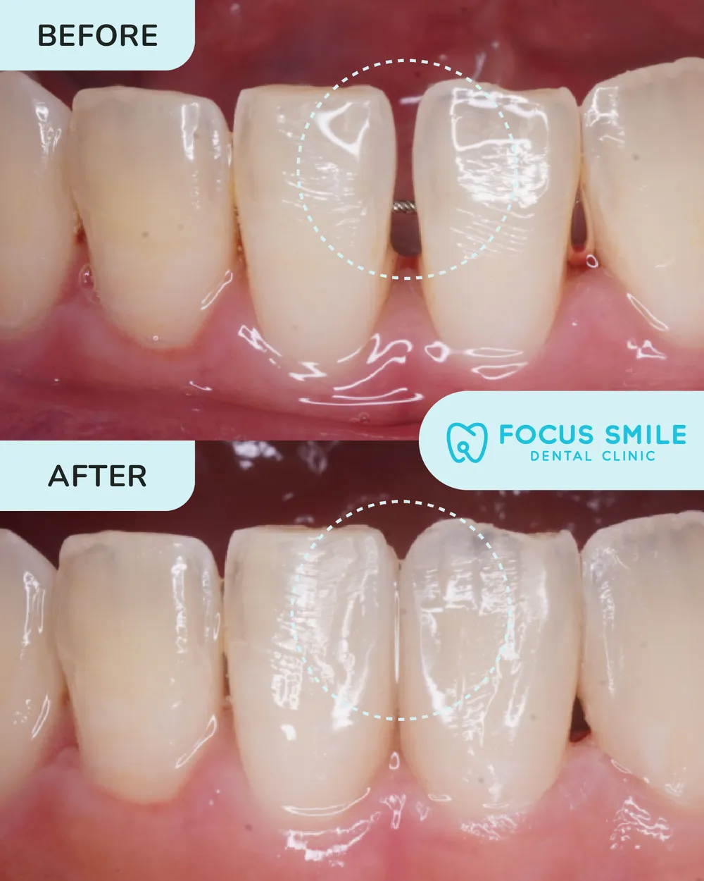 Dental filling before and after, case 4, at Focus Smile Dental