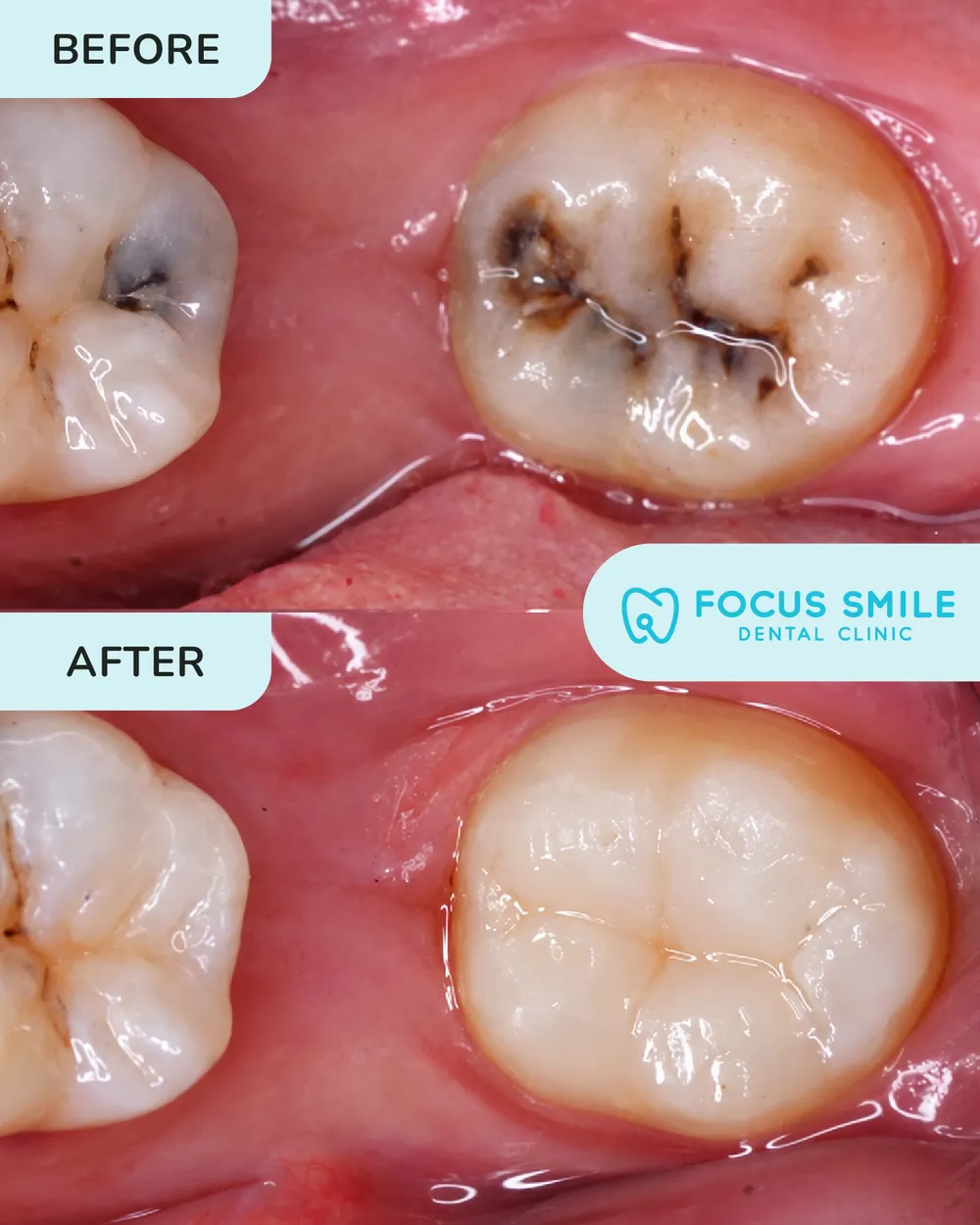 Dental Fillings before and after result at Focus Smile Dental