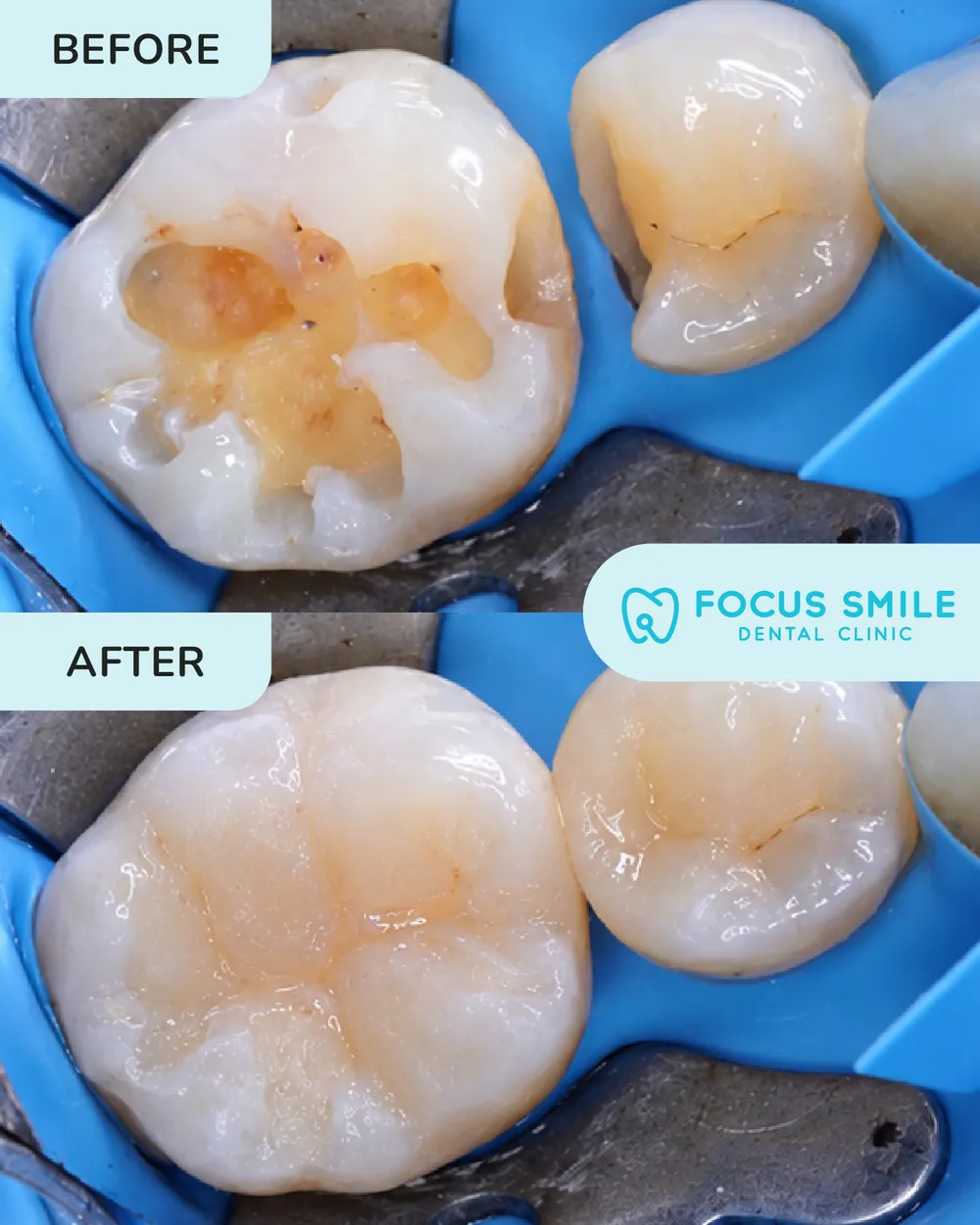 Dental filling before and after, case 6, at Focus Smile Dental