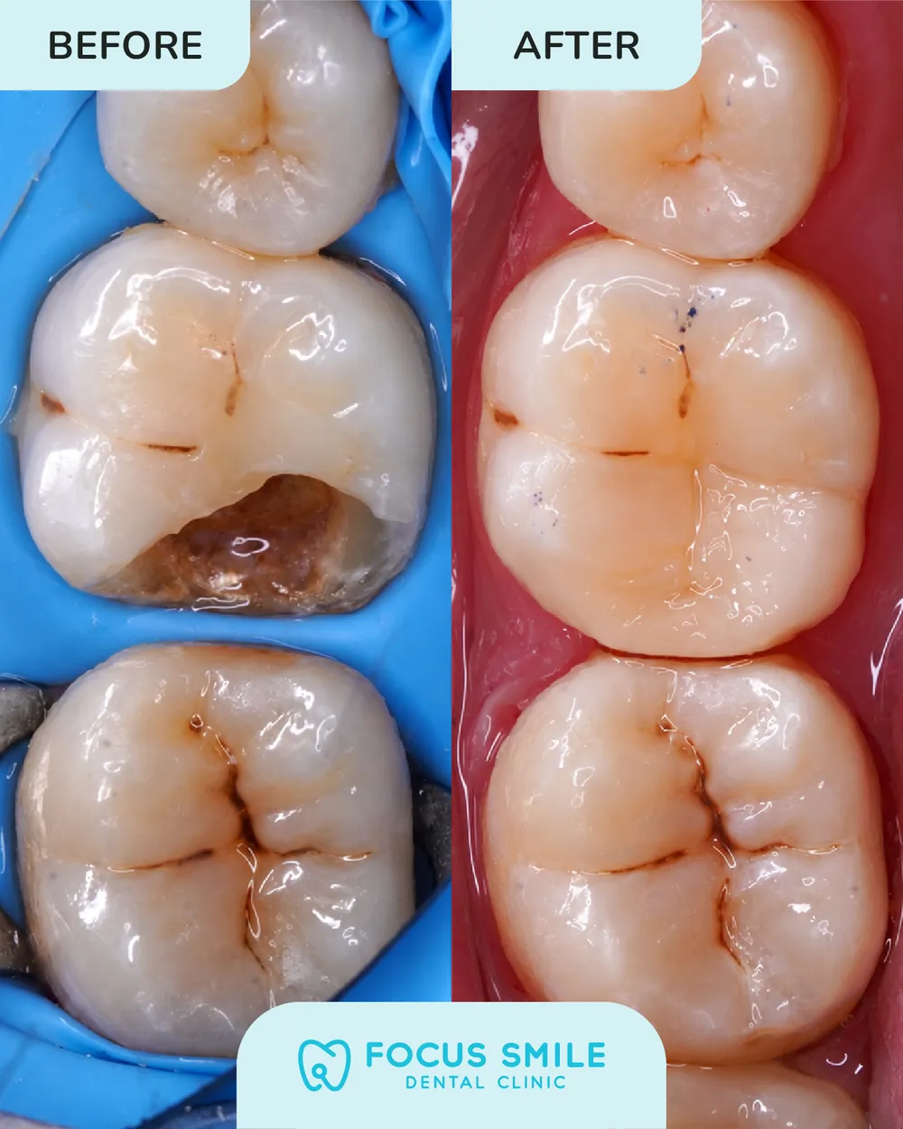 Dental Fillings before and after result at Focus Smile Dental