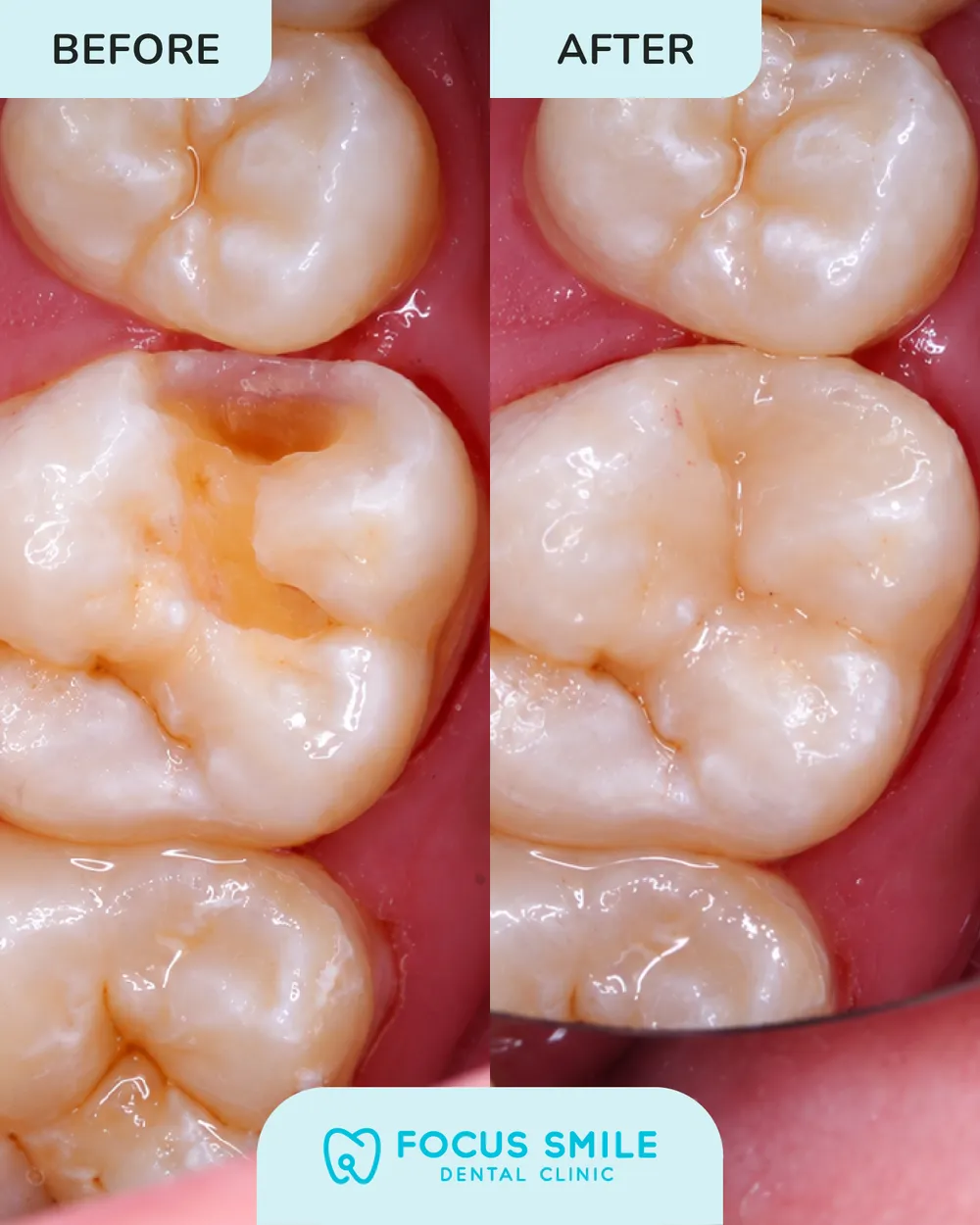 Dental filling before and after, case 8, at Focus Smile Dental