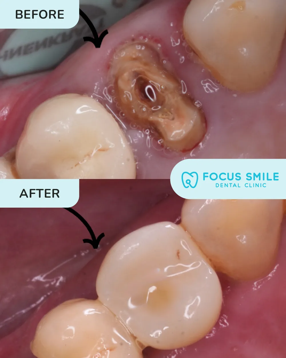 Dental Implants before and after result at Focus Smile Dental