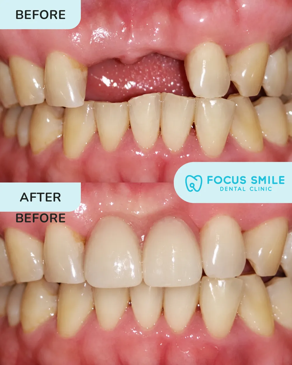 Denture before and after, case 1, at Focus Smile Dental
