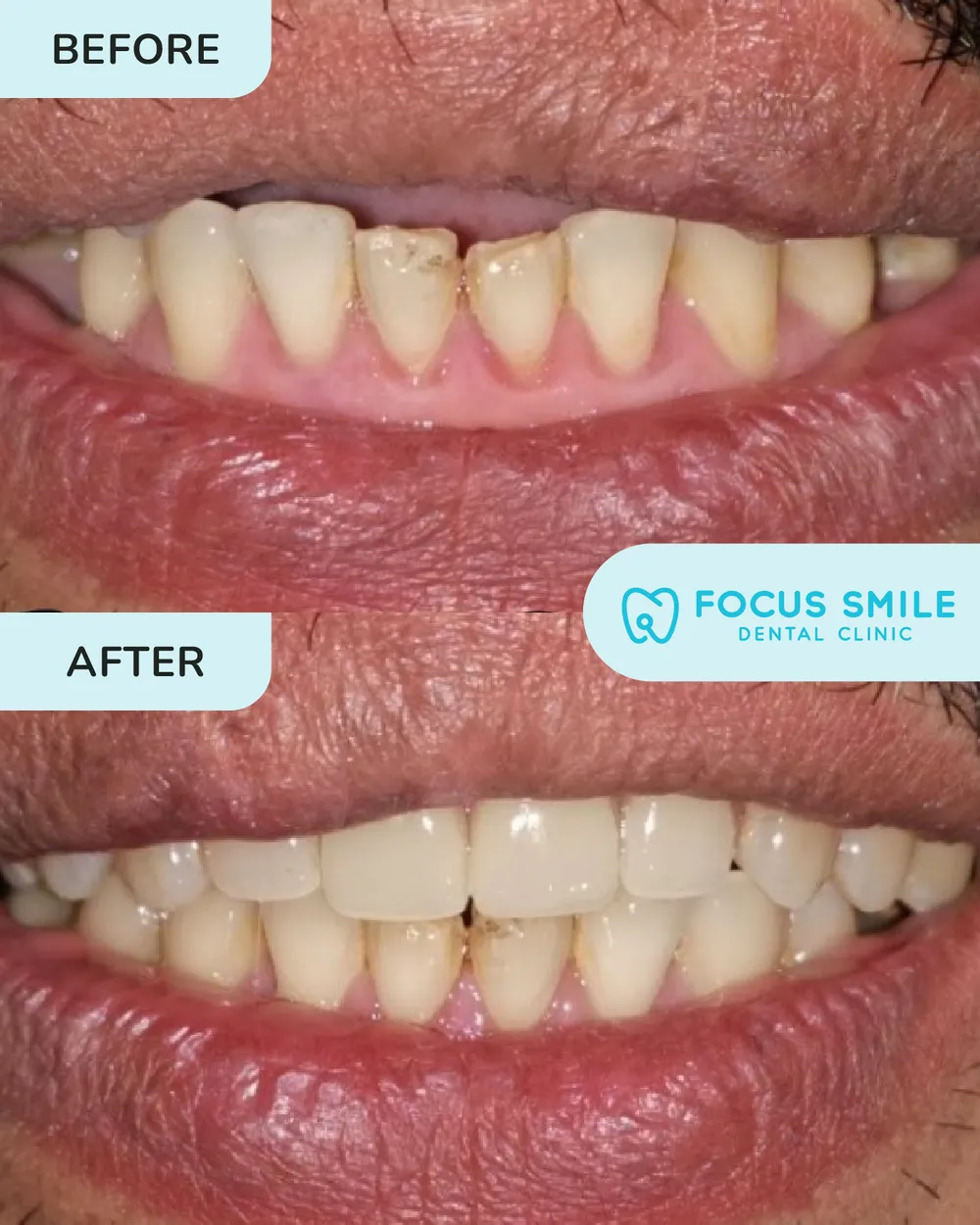 Dentures before and after result at Focus Smile Dental