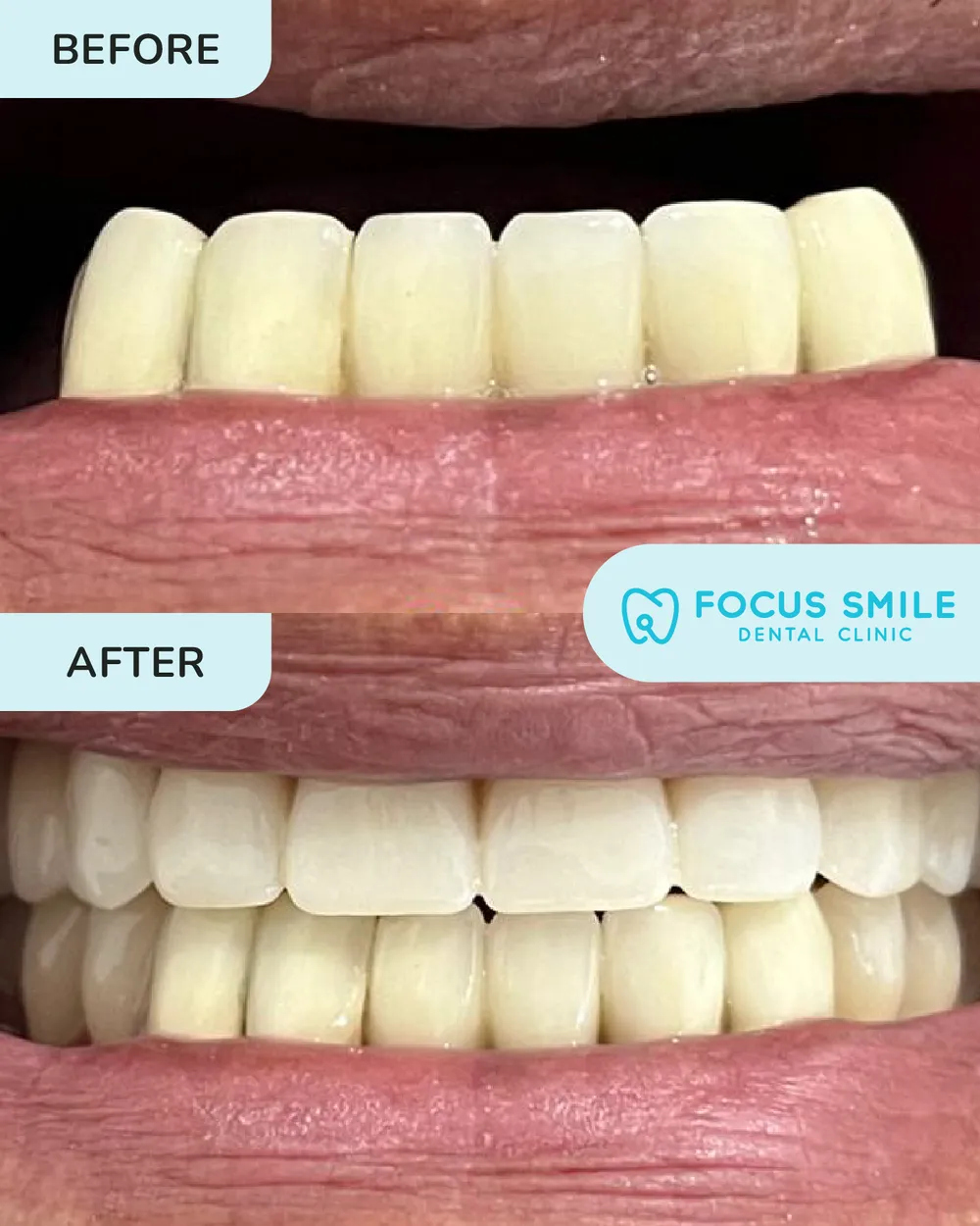 Denture before and after, case 3, at Focus Smile Dental