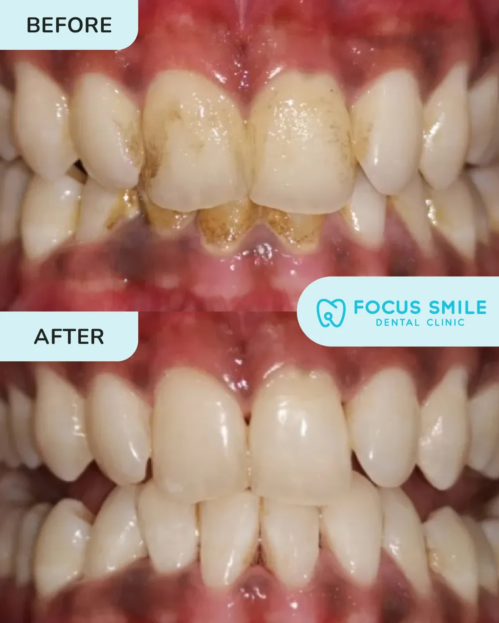 Scaling and polishing before and after, case 2, at Focus Smile Dental