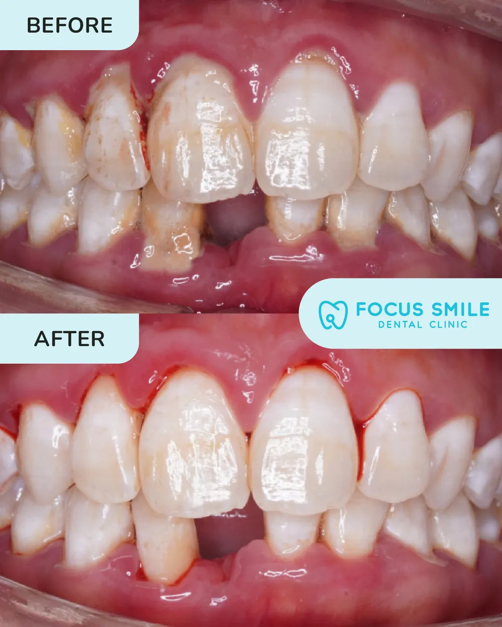 Scaling & Polishing before and after result at Focus Smile Dental