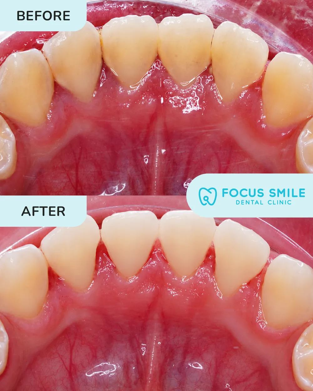 Scaling & Polishing before and after result at Focus Smile Dental