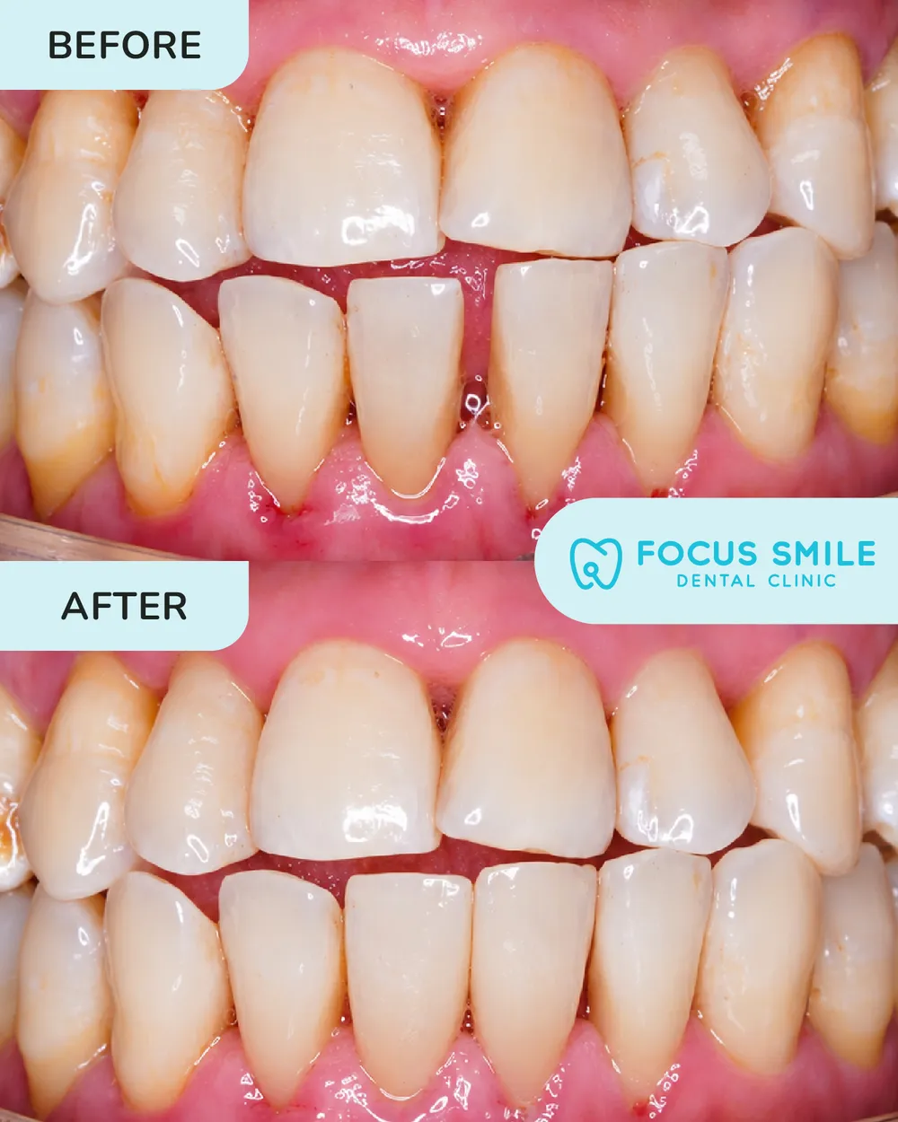 Scaling and polishing before and after, case 6, at Focus Smile Dental