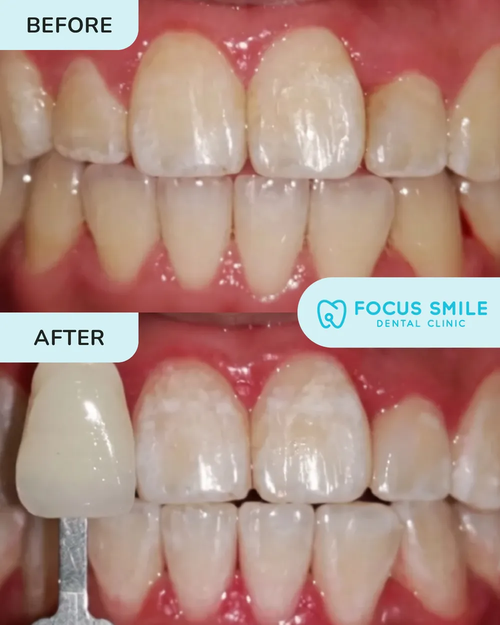 Teeth Whitening before and after result at Focus Smile Dental
