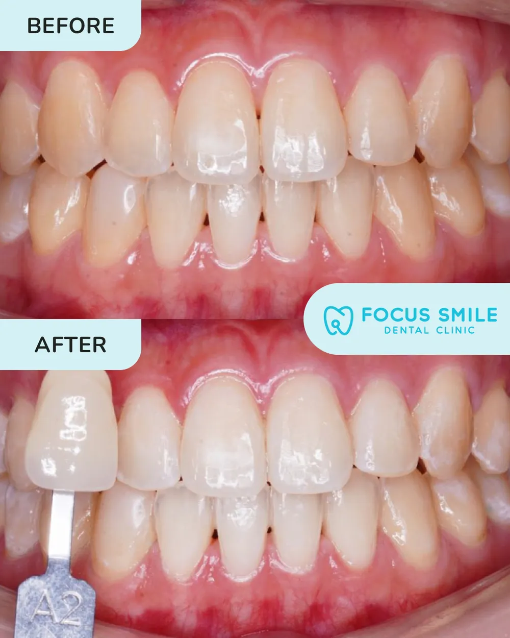 Teeth whitening before and after, case 2, at Focus Smile Dental