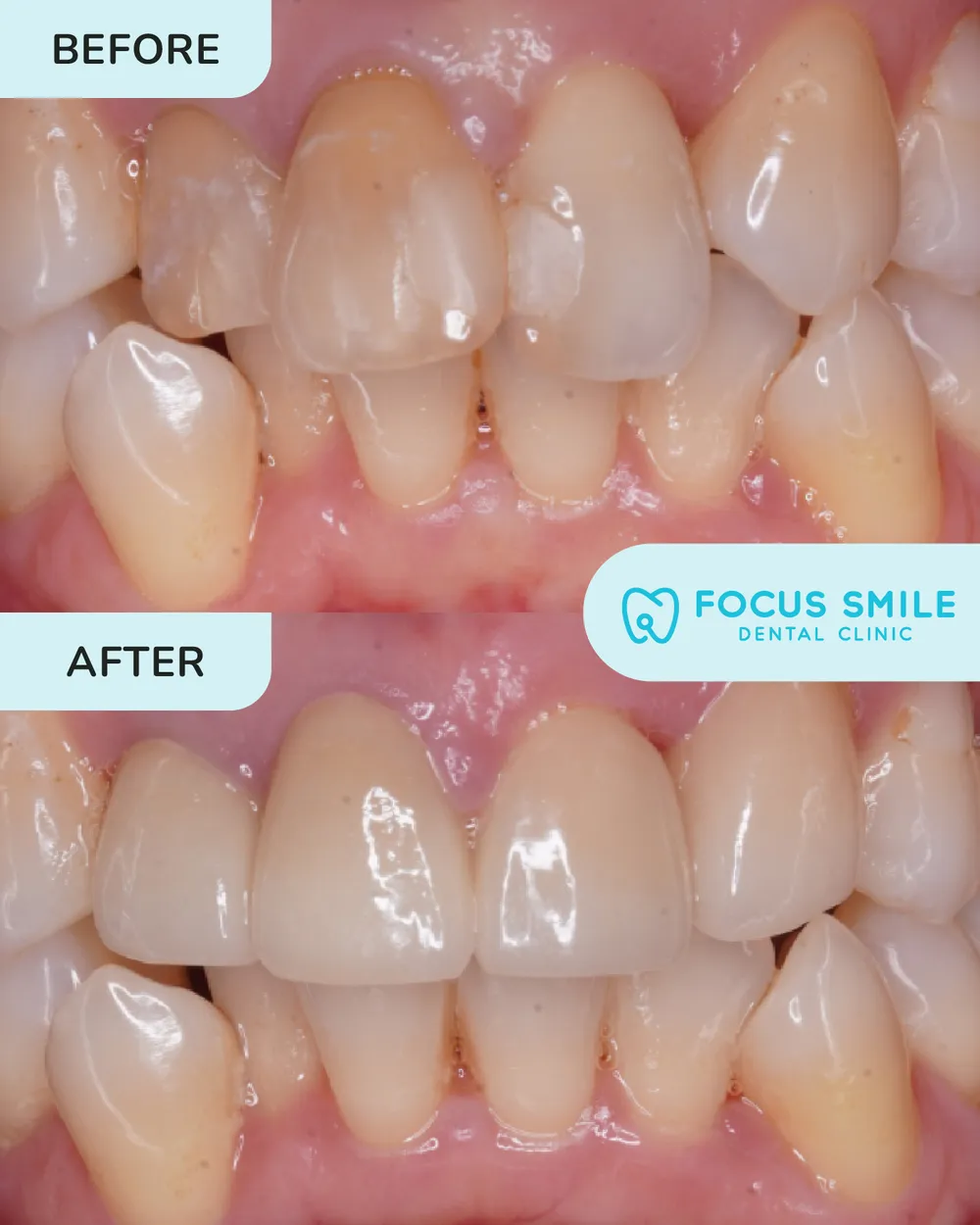 Veneers before and after result at Focus Smile Dental
