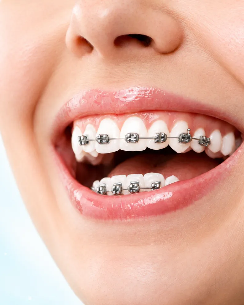 Close-up of a smile with metal braces on the upper and lower teeth
