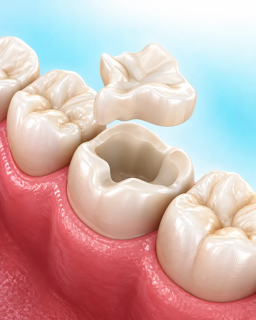 Illustration of a tooth-coloured restoration being fitted into a prepared back tooth
