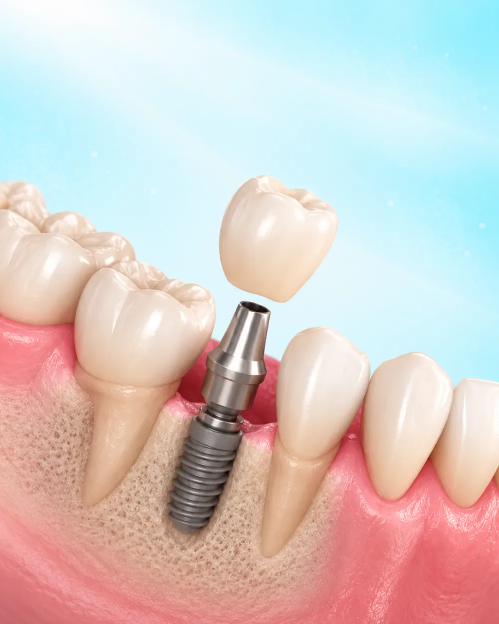 Illustration of a dental implant in the jawbone with its crown being placed
