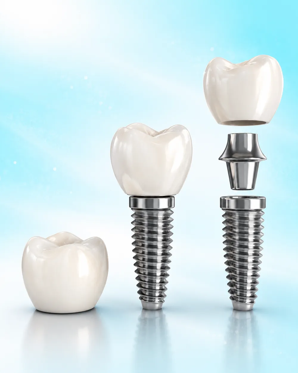 Illustration of an implant screw, abutment and crown beside a natural tooth