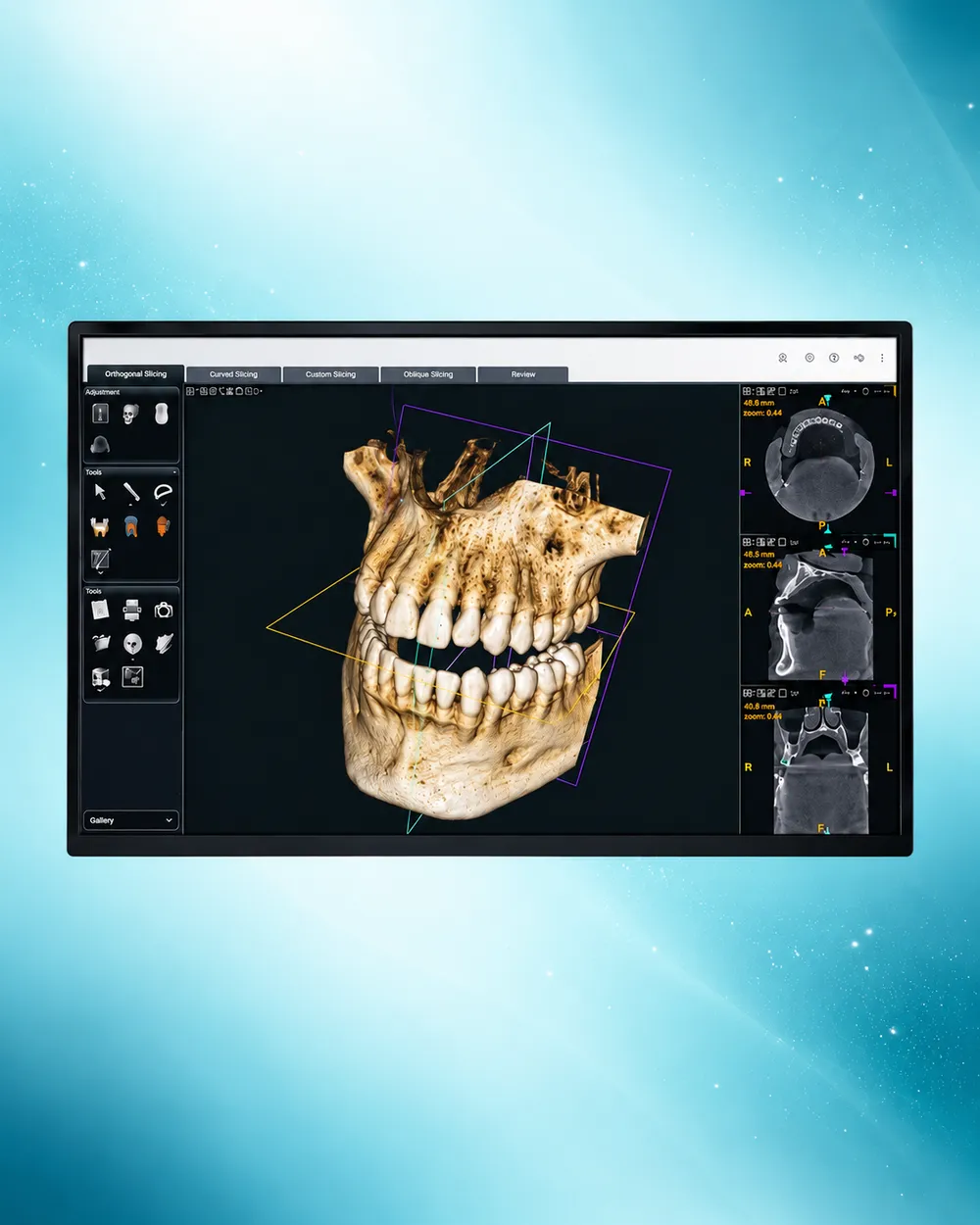 A 3D digital scan of the teeth and jaw shown on a screen