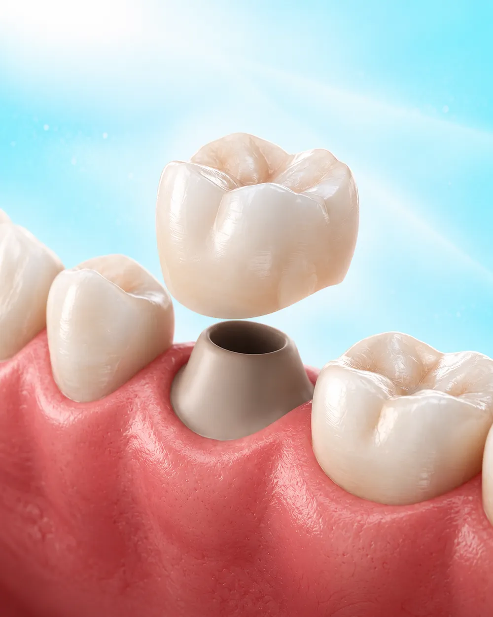 Illustration of a crown being fitted over a prepared back tooth