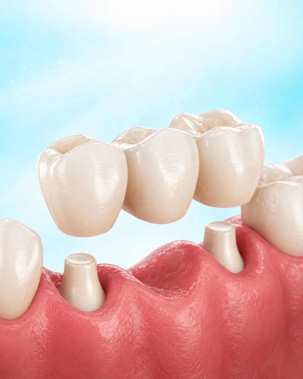 Illustration of a three-tooth bridge being fitted over two prepared teeth