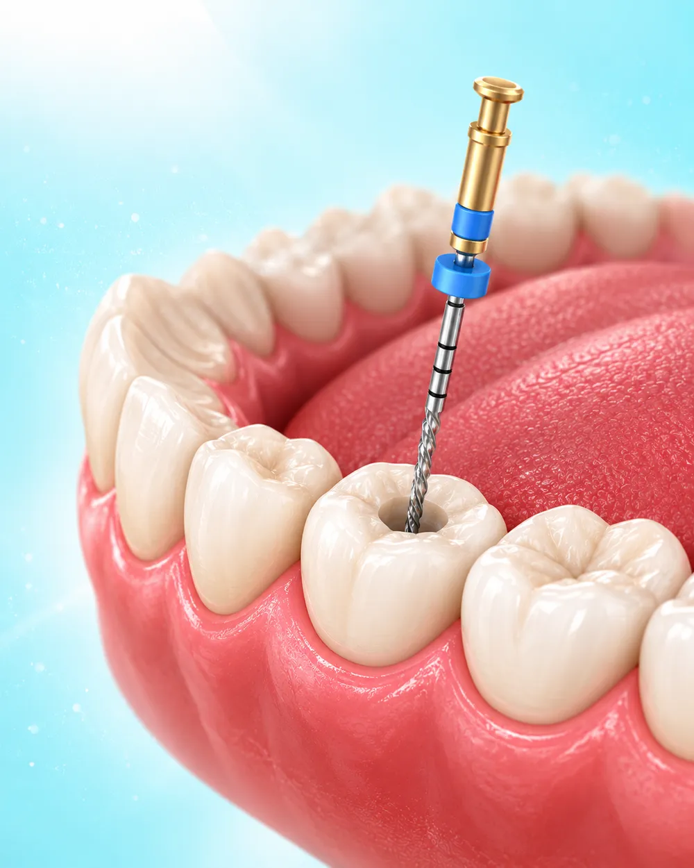 Illustration of a root canal file entering a back tooth