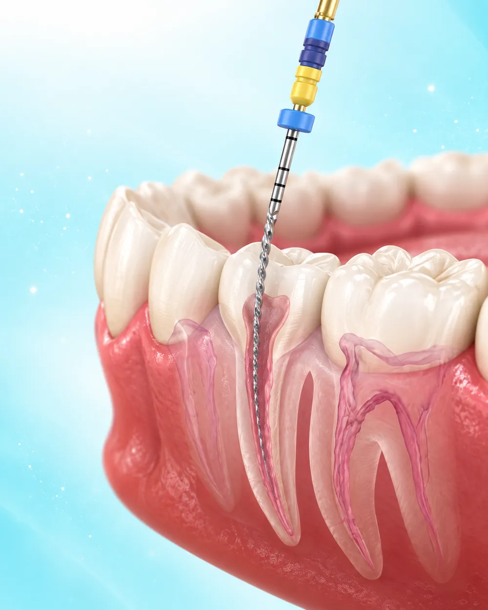 Cutaway illustration of a root canal file cleaning inside a tooth's roots