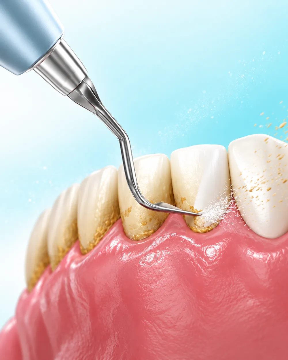 Illustration of an ultrasonic scaler removing tartar from the gumline