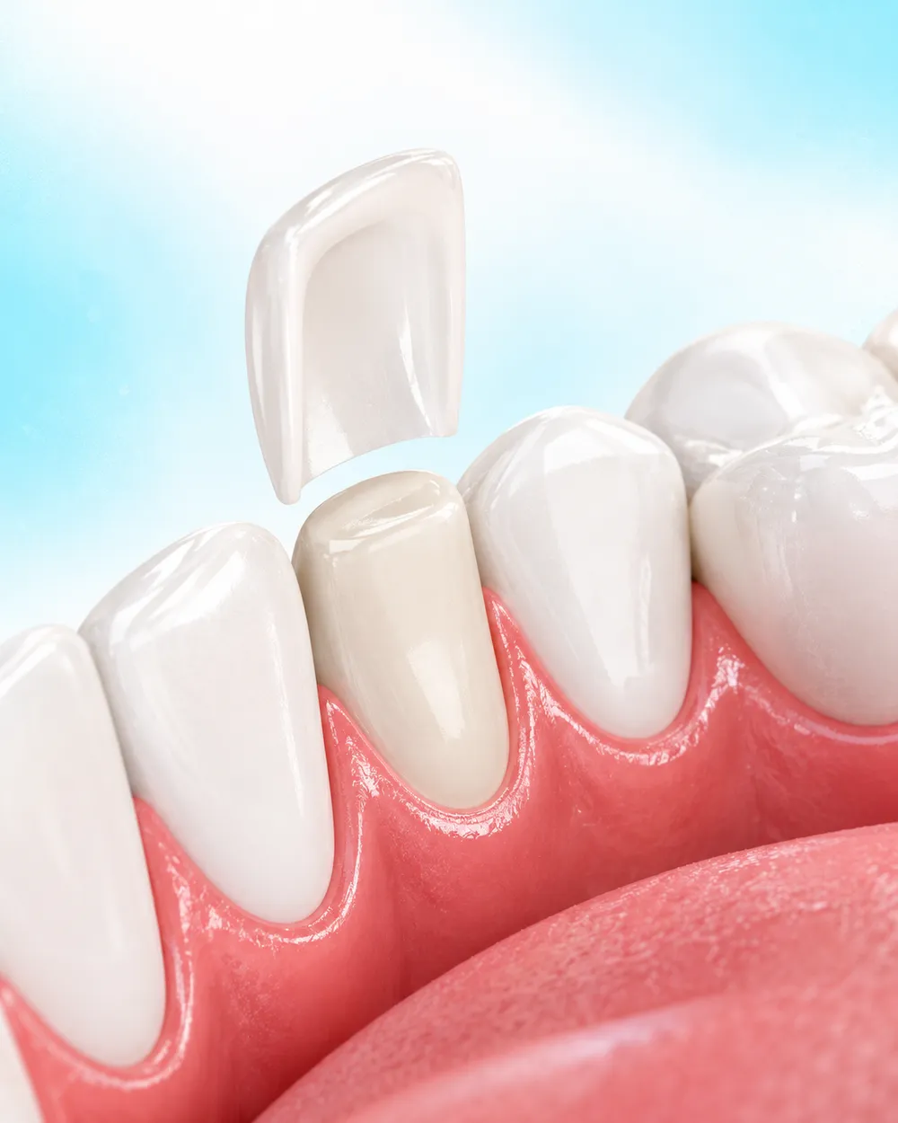 Illustration of a single veneer being fitted to a front tooth