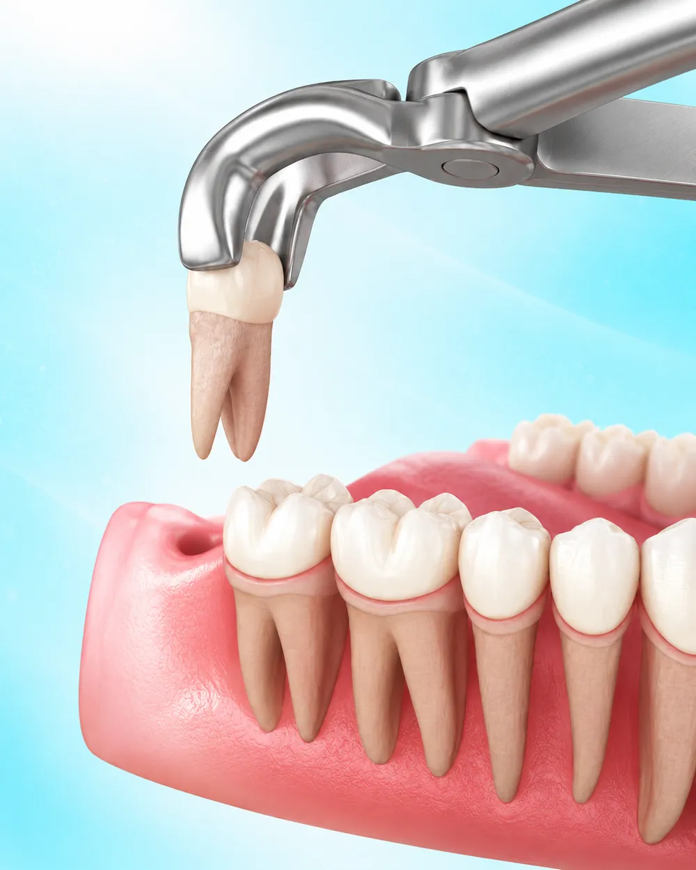Illustration of a wisdom tooth being removed from the back of the jaw